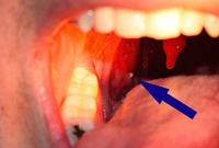 Where Tonsil Stones Are Found (image: Wikipedia.org)